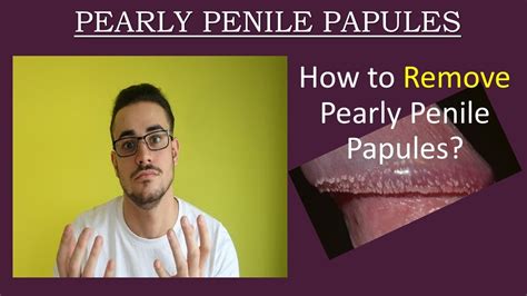 papule perlee penis|Pearly Penile Papule